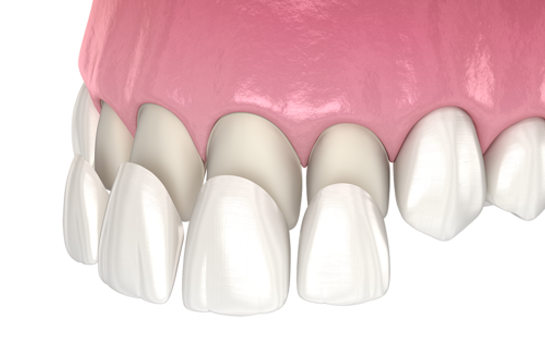 Seoul vs. U.S. Veneers: What the Savings Really Buy